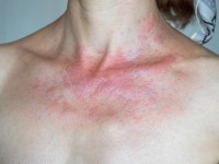 Zu sehen ist der Halsbereich einer Person mit roten Flecken, Bläschen und Pusteln.