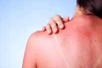 Sonnenbrand durch fehlende Sonnencreme bei Neurodermitis