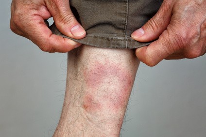 Mann mit Borreliose Symptomen von einem Zeckenbiss am Bein