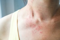 Frau mit Hautausschlag am Hals durch Histaminintoleranz