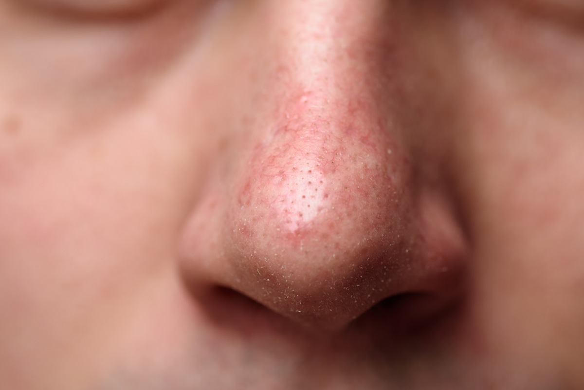 Rosacea Im Gesicht Tipps Infos Volksversand Versandapotheke