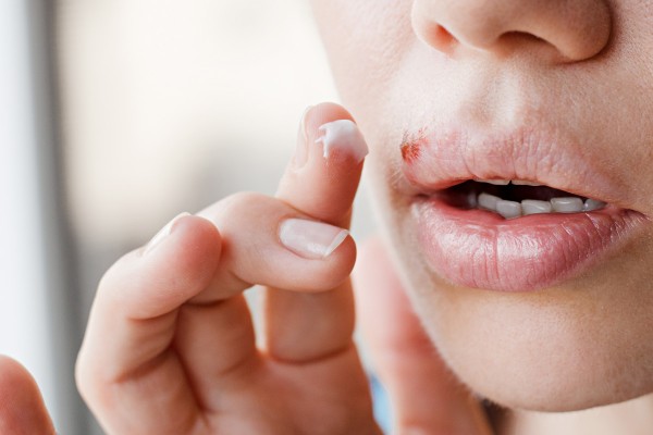 Lippenherpes Ansteckung Wichtige Infos Volksversand Versandapotheke
