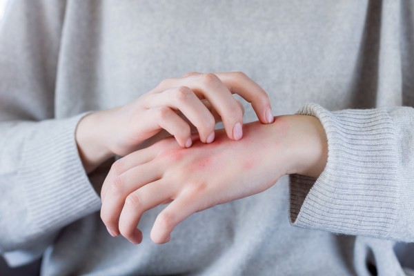 Frau mit Neurodermitis an der Hand kratzt sich.