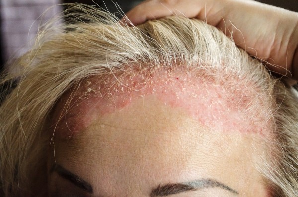 Frau mit Neurodermitis auf der Kopfhaut hält das Haar zurück.