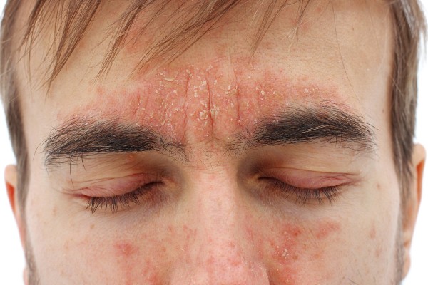Mann mit Neurodermitis im Gesicht