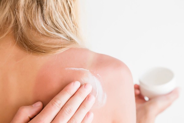 Frau verteilt After Sun auf Schultern mit Sonnenbrand