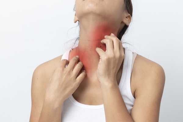 Erwachsene mit Neurodermitis kratzt sich wunde Stellen am Hals.