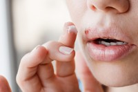 Frau tupft sich nach Ansteckung mit Lippenherpes Salbe auf Bläschen